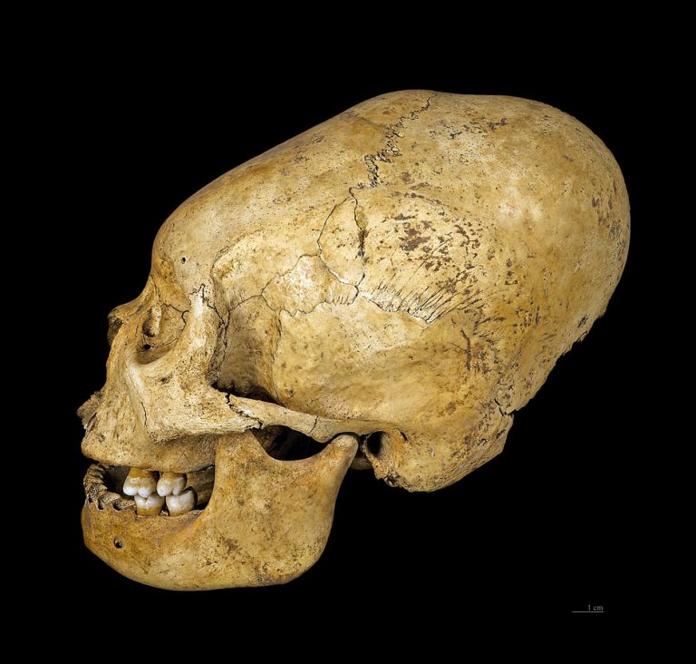 Proto Nazca deformed skull, c 200–100 BC.